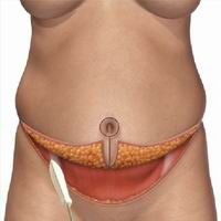 illustration of excess skin lifting