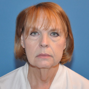 facial surgery before image