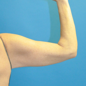 facial surgery after image