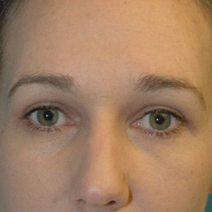 facial surgery after image