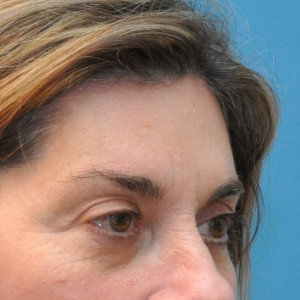 5e506db098db1 facial surgery after image