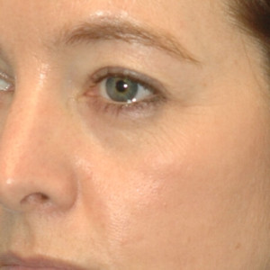 facial surgery before image