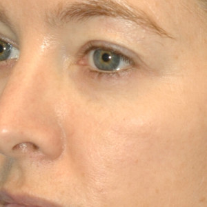 facial surgery after image