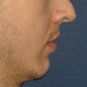 facial surgery before image