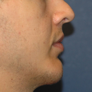 facial surgery after image