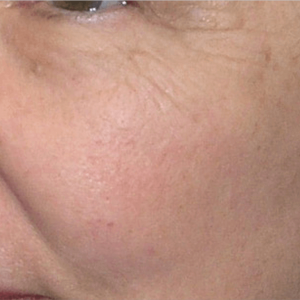 facial surgery after image