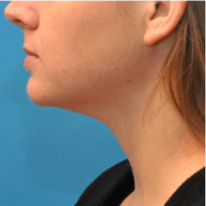 facial surgery after image