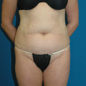 5e557c299f969 facial surgery before image