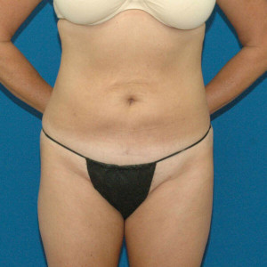 5e557c2a9fb9f facial surgery after image