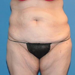 facial surgery before image