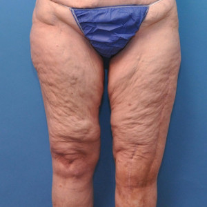 facial surgery before image