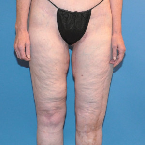 facial surgery after image