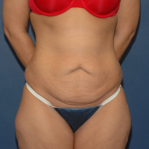 facial surgery before image