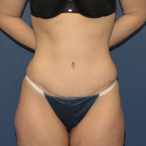 facial surgery after image