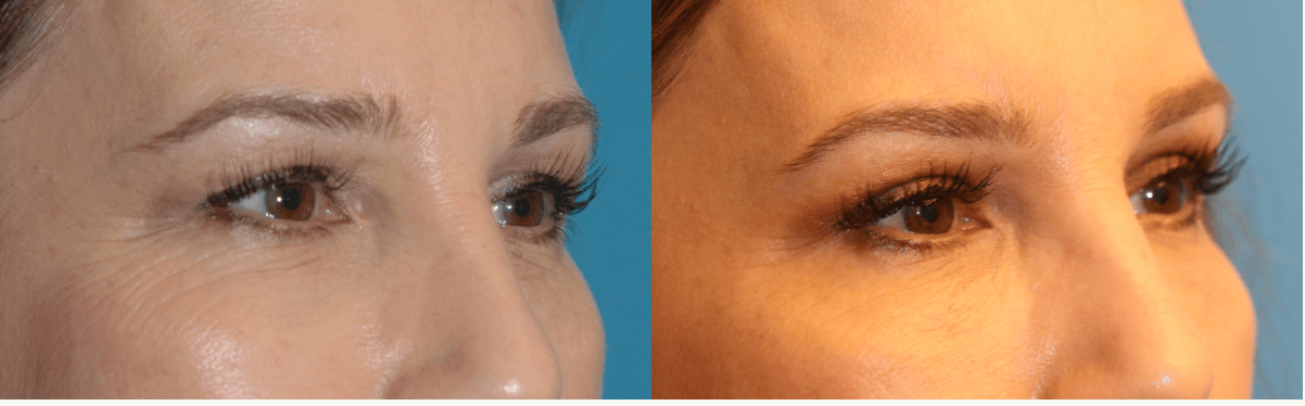 before and after results of eyelid lift surgery