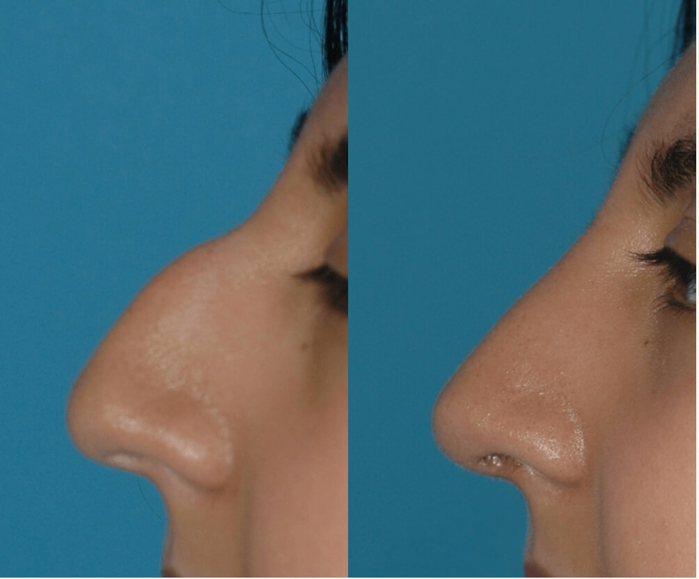 5e7e9b40525f4 before and after rhinoplasty results
