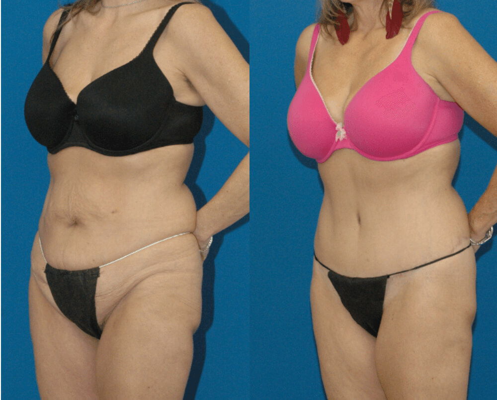 before and after photos of a lower body lift