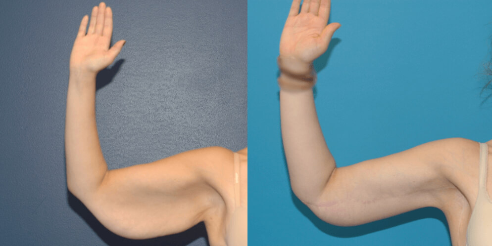 before and after photos of arm lift surgery