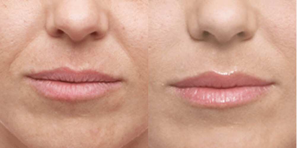 Before and after photo of a woman with dermal fillers