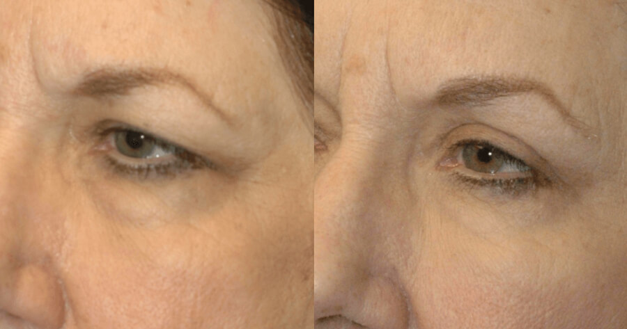 6812a901b277d before and after photos of browlift surgery