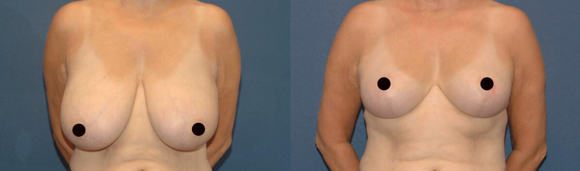 Before and after photo of a woman with a breast lift