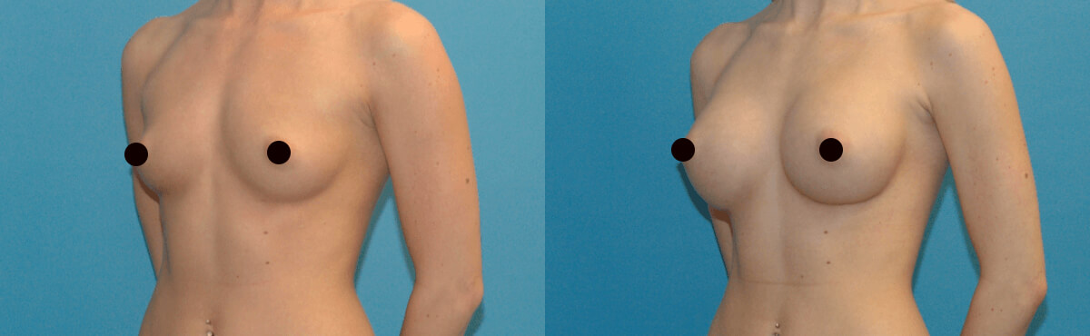 68d5898282904 before and after results of breast augmentation surgery