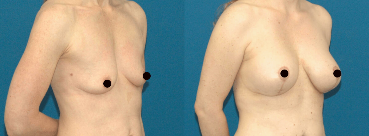 Before and after photo of a woman with breast lift with implants