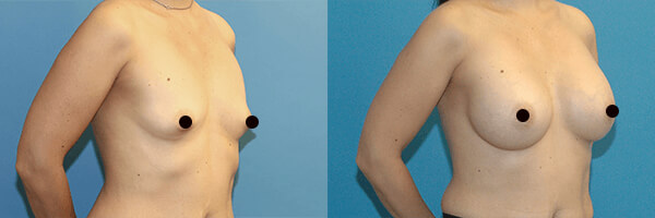 before and after result of breast implant