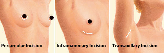 illustration of incision placement for breast implants