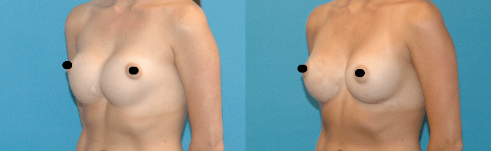 before and after results of breast revision surgery