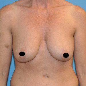 d8b52ae8-a2f6-48c4-b8f8-959a8a88d1d5 facial surgery after image