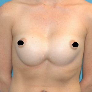 facial surgery before image