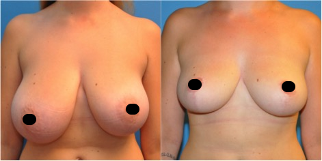 Before and after photo of a woman with breast reduction