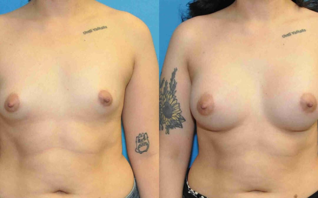 Breast Implant #127