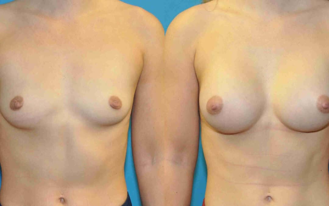Breast Implant #128