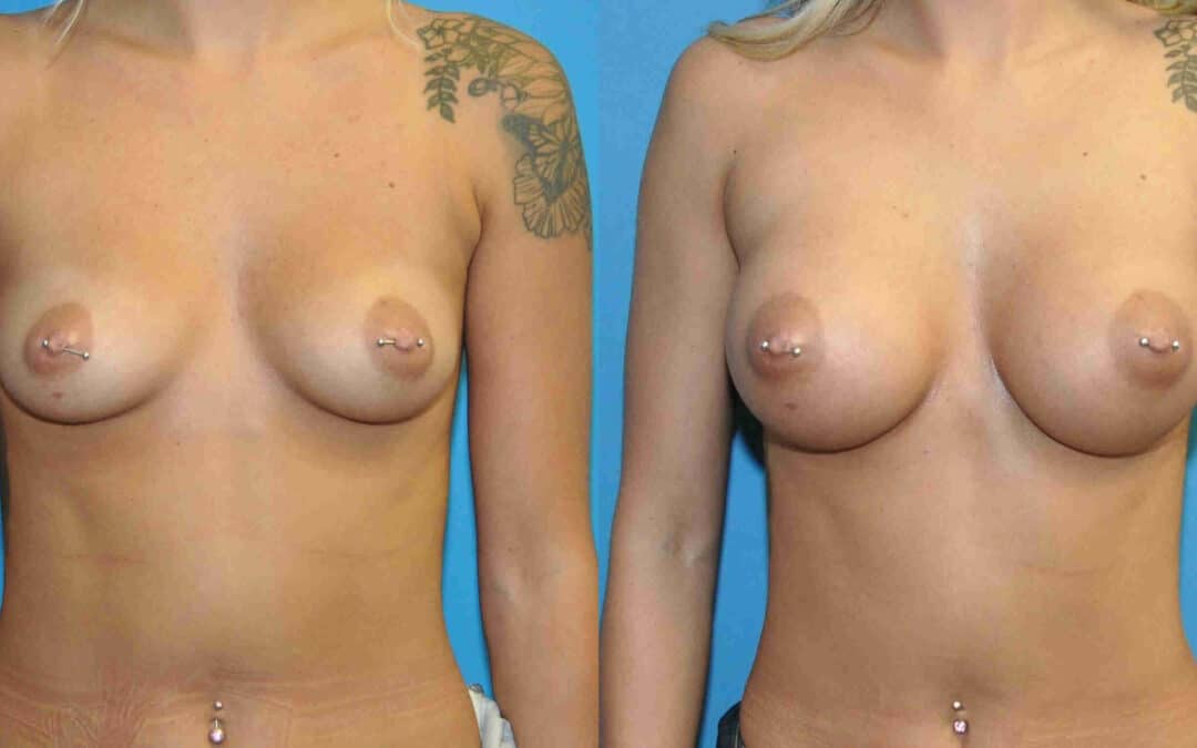 Breast Implant #2