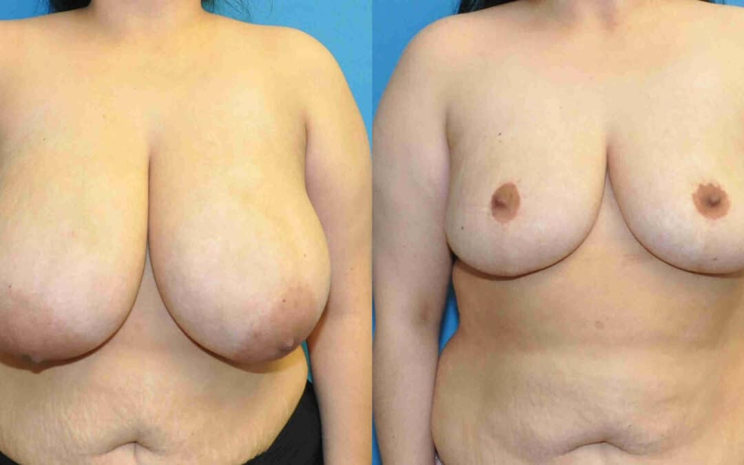 Breast Reduction #3