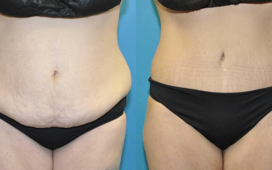 Tummy Tuck #57