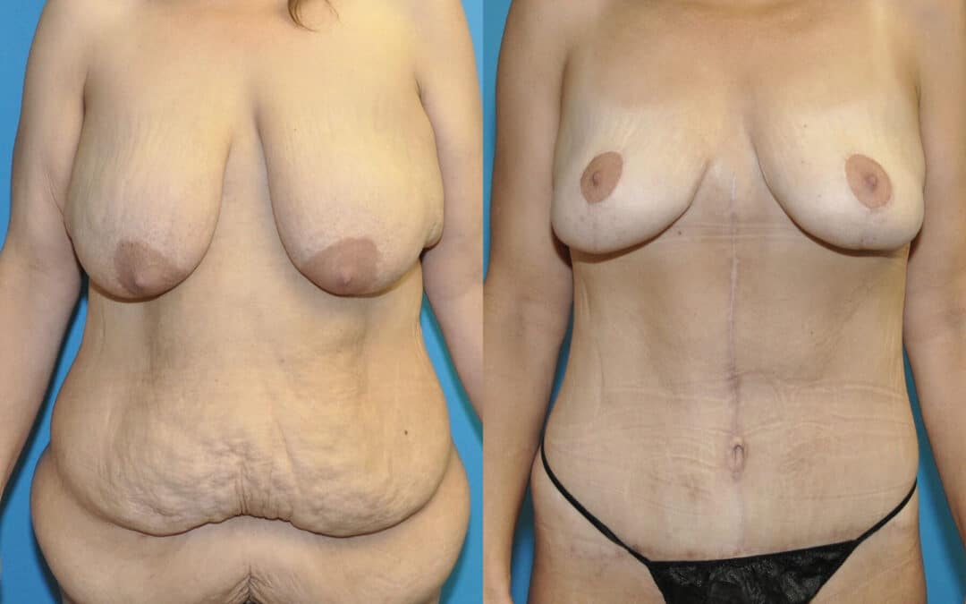 Breast Lift, Lower Body Lift, Bra roll/Upper Back Lift #1