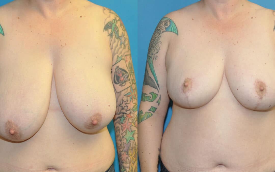 Breast Reduction #2