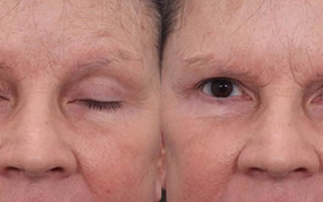Upper Blepharoplasty (Eyelid Lift) #1