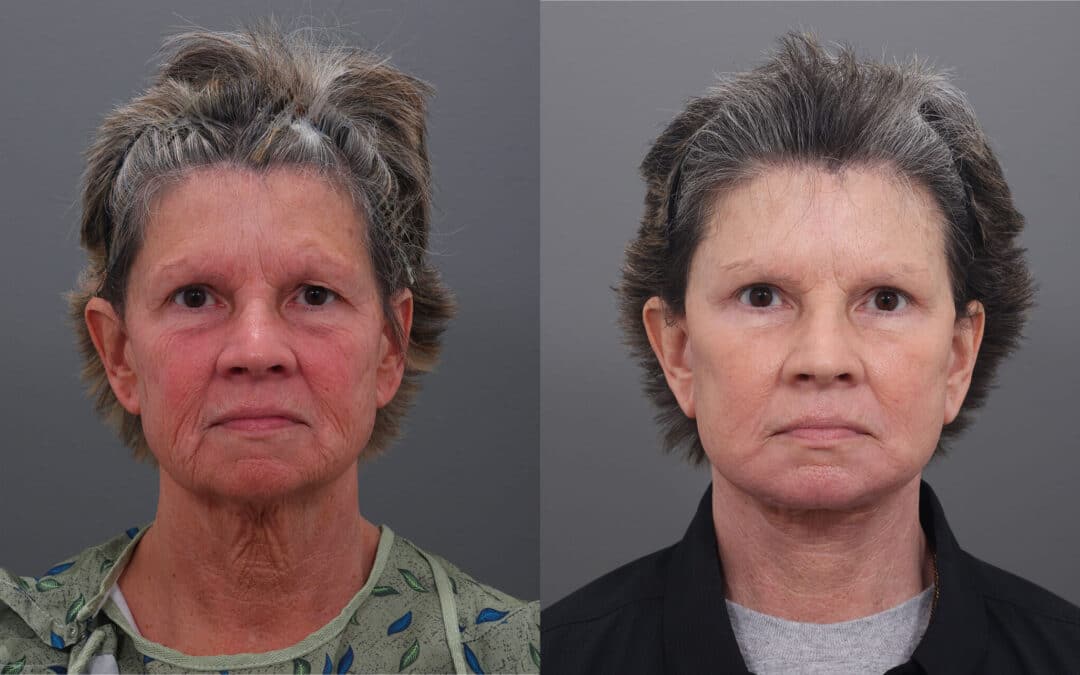 Face and Neck Lift #1